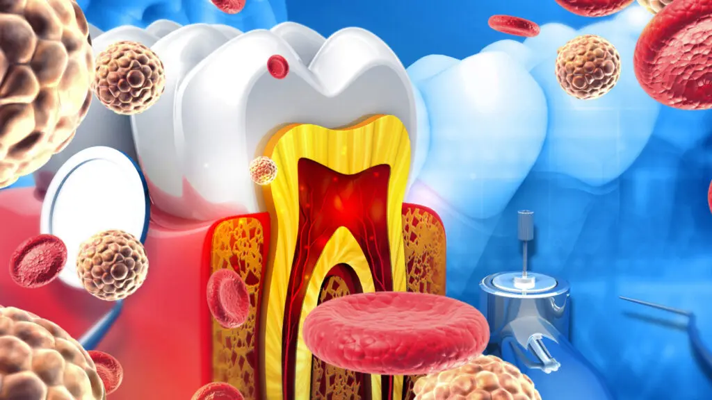 Mekanisme respon imun tubuh terhadap bakteri penyakit gusi