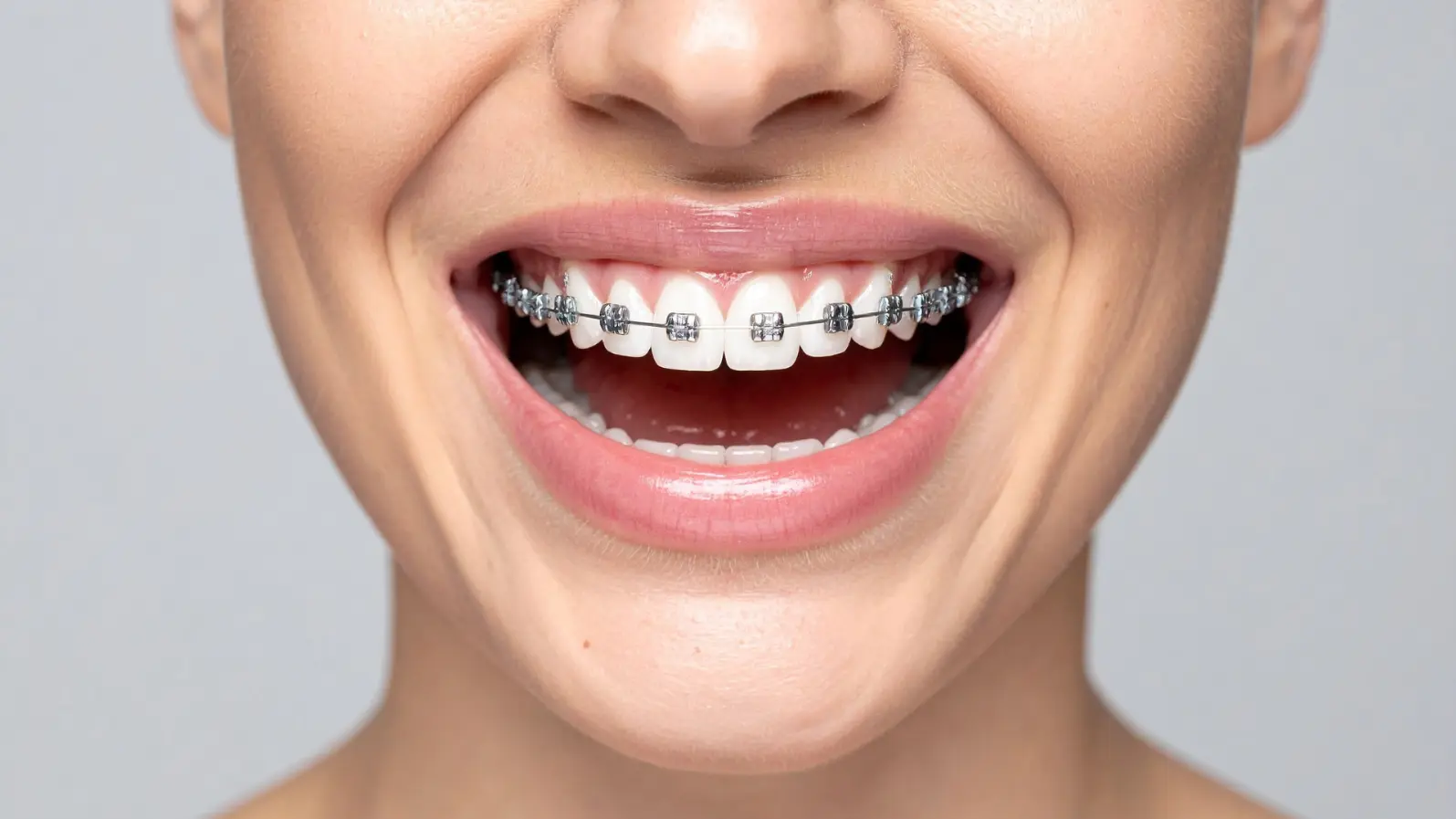 Apakah Antioksidan Alami Bisa Membantu Bracket Ortodonti Lebih Kuat Setelah Bleaching Gigi?