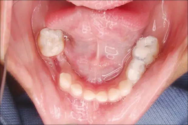 Dampak Gigi Susu Tanggal Dini pada Susunan Gigi Anak