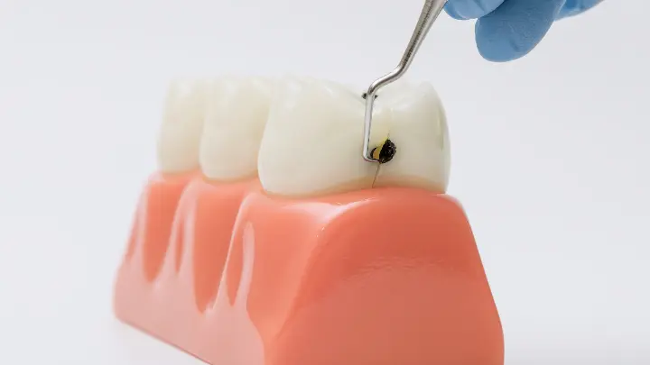 Vaksin Gigi Berlubang: Masa Depan Pencegahan Karies Gigi