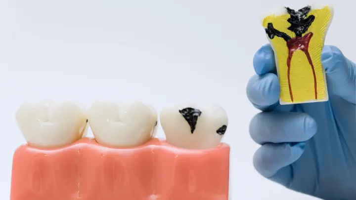 Kaitan Jamur & Bakteri pada Karies Gigi