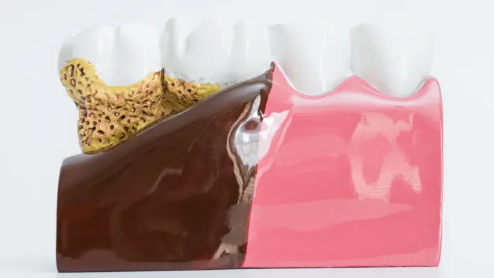 Efektivitas Splinting Gigi dalam Regenerasi Periodontal