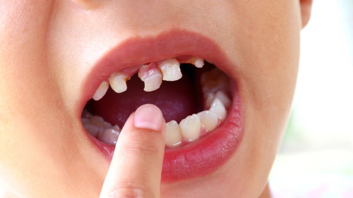 Anak Rajin Sikat Gigi Tapi Berlubang?