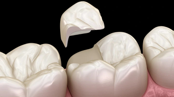 Nanoteknologi Perkuat Tambalan Gigi