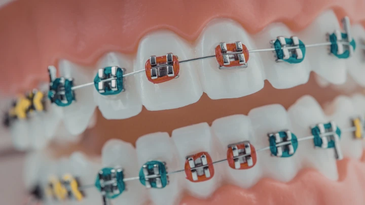 Behel pada Gigi Root Canal & Risiko Tulang