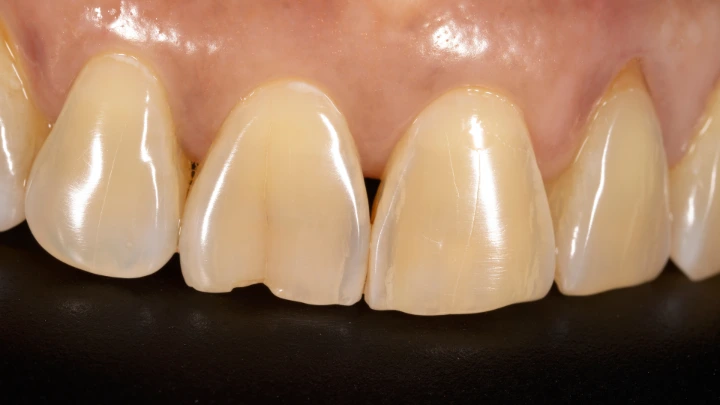 Usia Gigi &amp; Kekuatan Semen Pasak