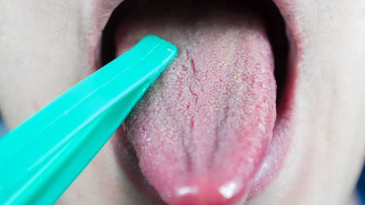 Kanker Gusi &amp; Dasar Mulut Lebih Agresif