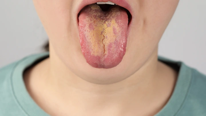Radioterapi & Kandidiasis Oral