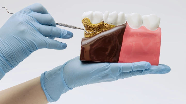 Prediksi AI Kehilangan Gigi Periodontitis