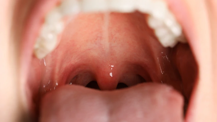 Patogenesis & Diagnosis Burning Mouth Syndrome