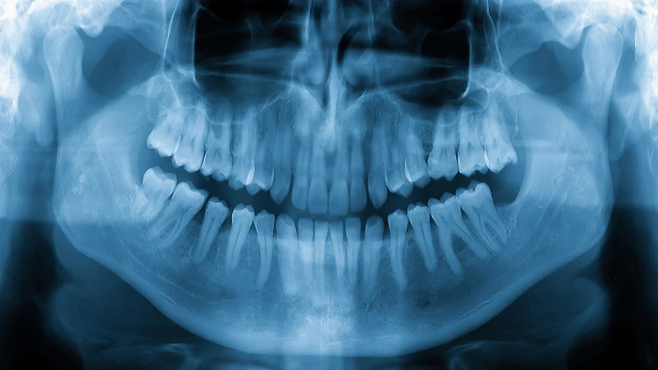 Akurasi Clear Aligner pada Gigi Berjejal