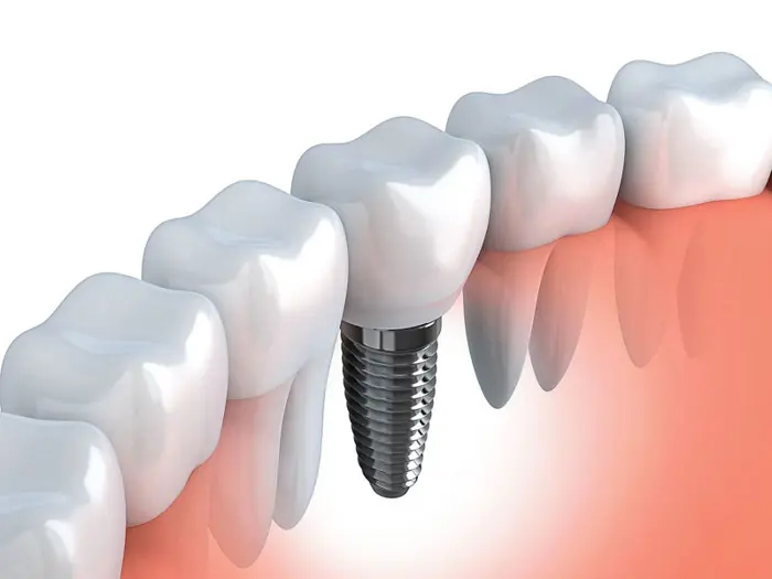 Pencegahan Infeksi Peri-Implantitis Gigi