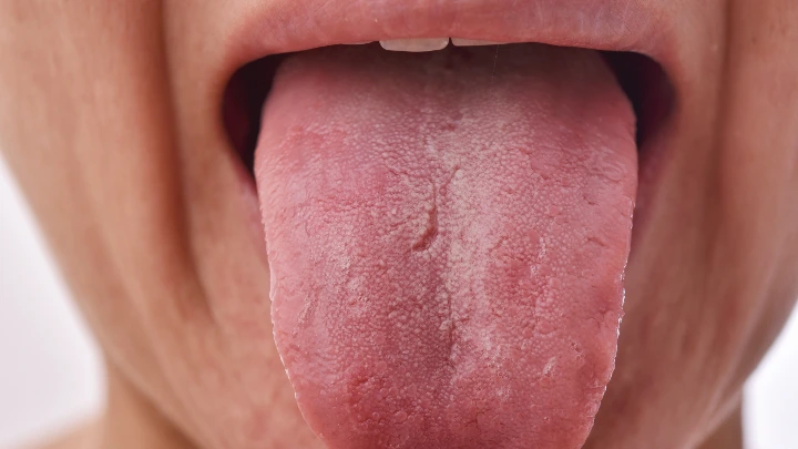 Pemanfaatan Tongue Bite Cetak 3D Radioterapi 