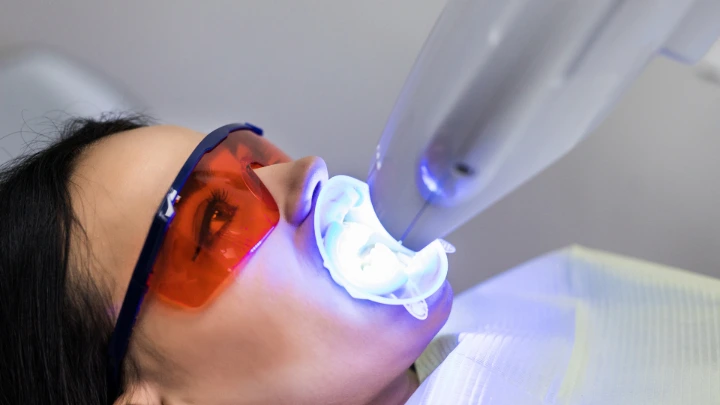 Bleaching Gigi Laser vs LED: Mana Ramah Enamel?