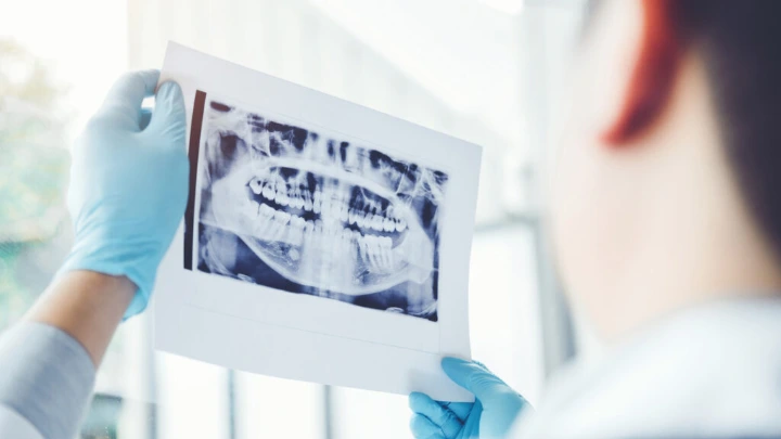Periodontitis Faktor Risiko Osteoporosis