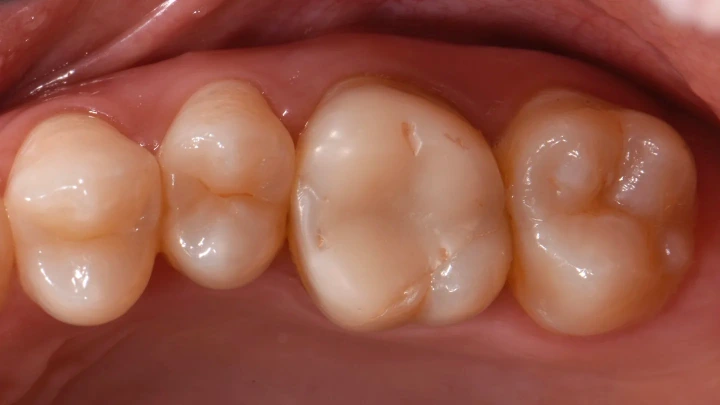 Restorasi Biomimetik Pasca-Endodontik