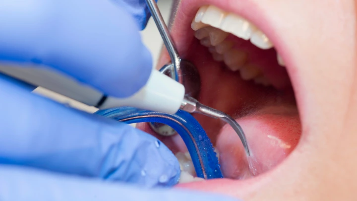 Scaling Ultrasonik vs Manual Root Planing Subgingiva