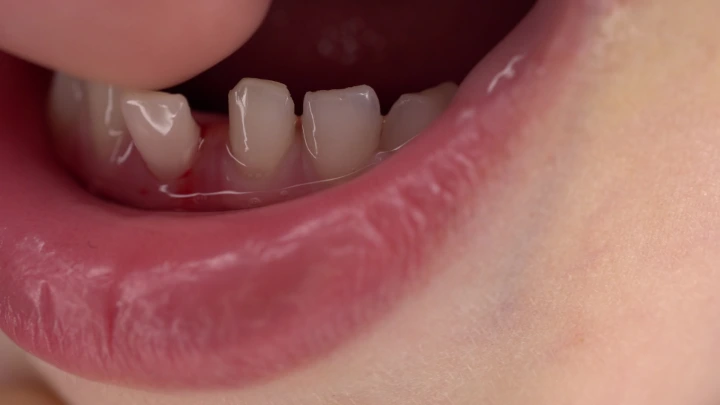Terapi Periodontal Non-Bedah untuk Gigi Goyang