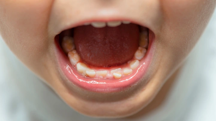 Molar-Incisor Hypomineralisation (MIH) pada Gigi Anak