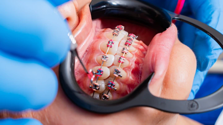 Ortodonti Perawatan Molar Impaksi Horisontal