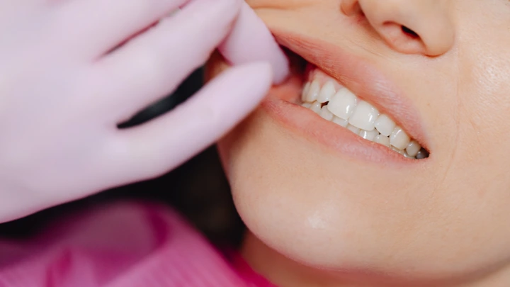 Dilated Odontoma Dens in Dente Gigi Anak